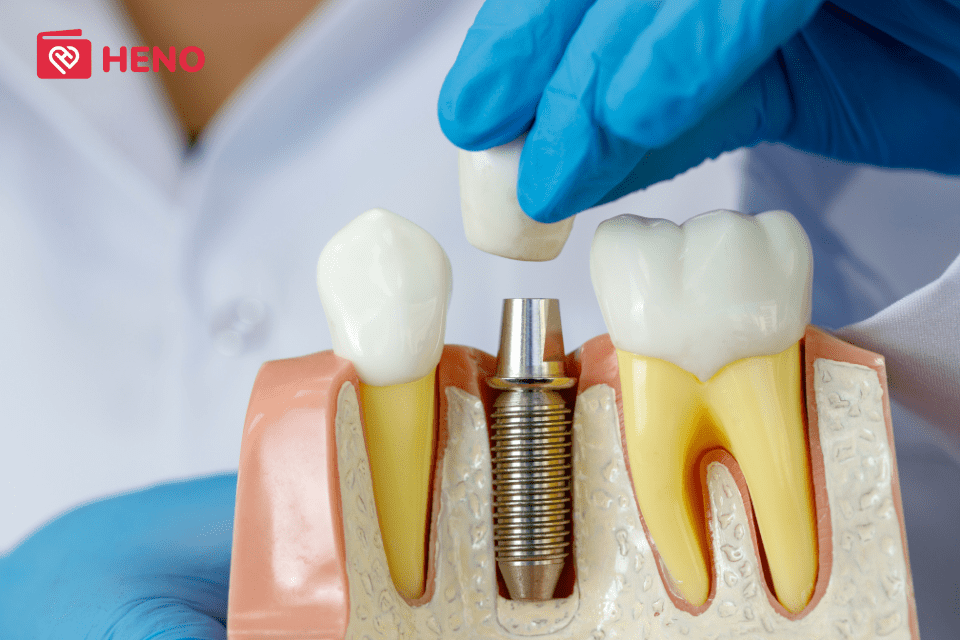Cấy Implant có đau không - Cách chăm sóc răng sau khi cấy Implant